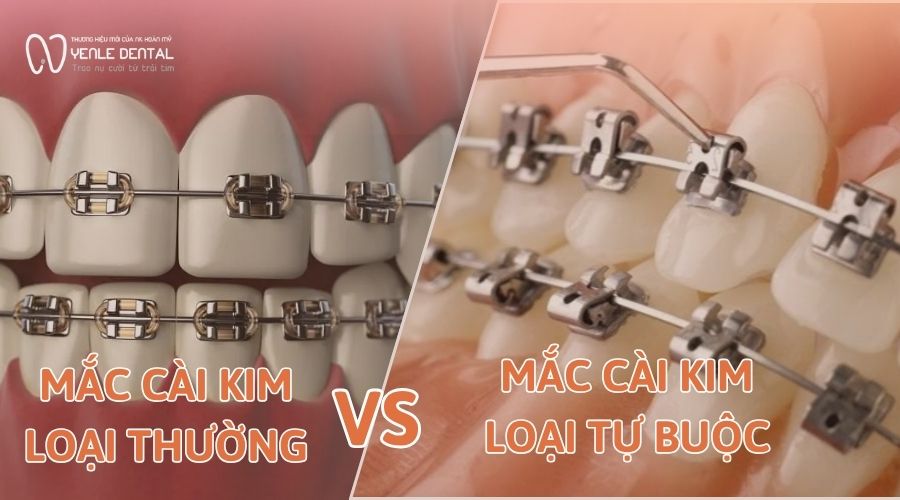 mắc cài kim loại thường với mắc cài kim loại tự buộc